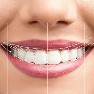 mejor dentista en miami, carillas de porcelana miami, botox miami, costo de endodoncia miami, elevación de seno en miami, mejores carillas miami, mejor dentista del sur de florida, mejor dentista cosmético miami, mejor atención dental miami, sage dental, g dental, dr g smile