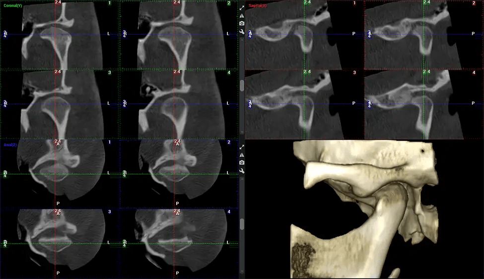 Planmeca CBCT Low Radiation G7 TMJ Study